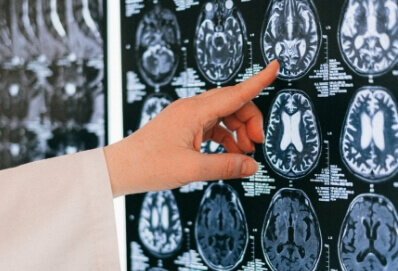 Brain and Head Injuries